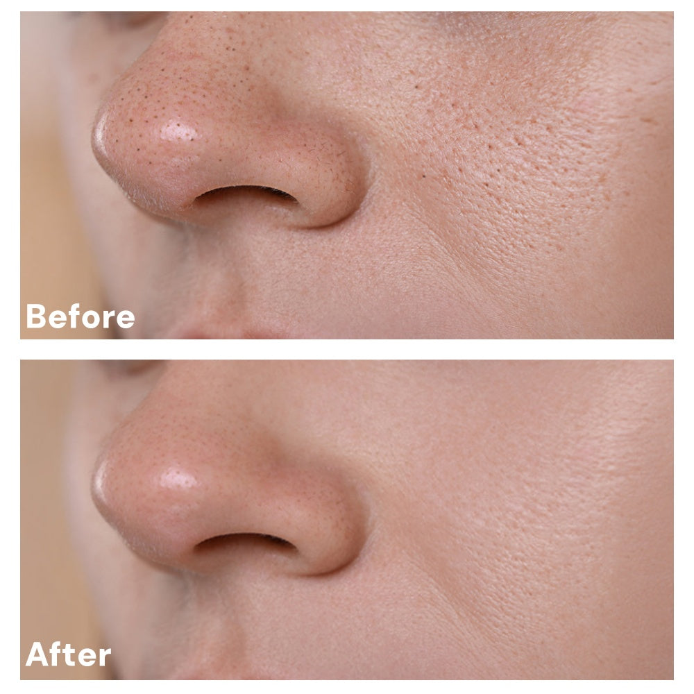 7,500 PPM Needle Facial Serum, say goodbye to damaged skin